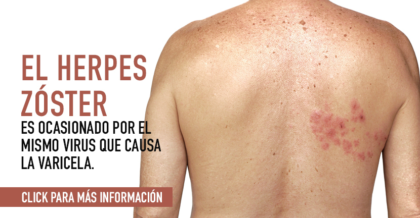 Herpes Zóster